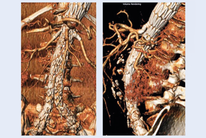 Midterm, real-world data strengthen use of Gore Viabahn VBX balloon-expandable endoprosthesis for F/BEVAR