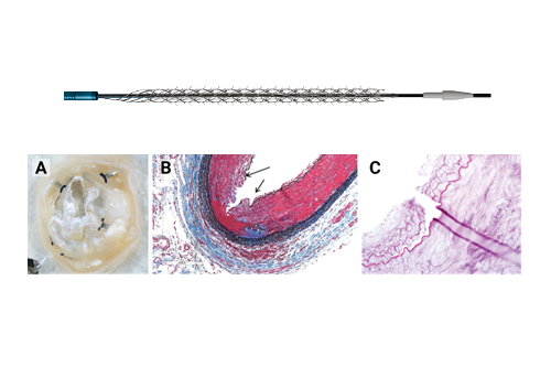 Spur RST: a novel approach to address limitations in BTK CLTI