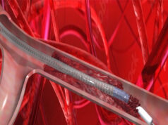 VentiV Scientific completes first-in-human use of V-Pulse mechanical thrombectomy system