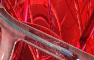 VentiV Scientific completes first-in-human use of V-Pulse mechanical thrombectomy system
