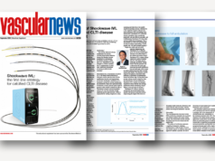 Shockwave IVL: the first-line strategy for calcified CLTI disease