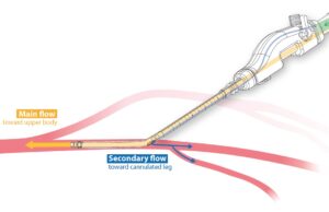 iPerf concludes clinical trial of novel dual-lumen femoral arterial cannula for cardiopulmonary support